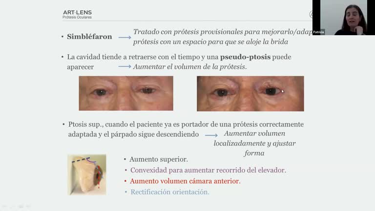 Seminario sobre prótesis oculares.